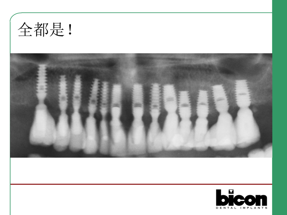 Bicon种植系统修复方式(全套课件213P).ppt_第3页