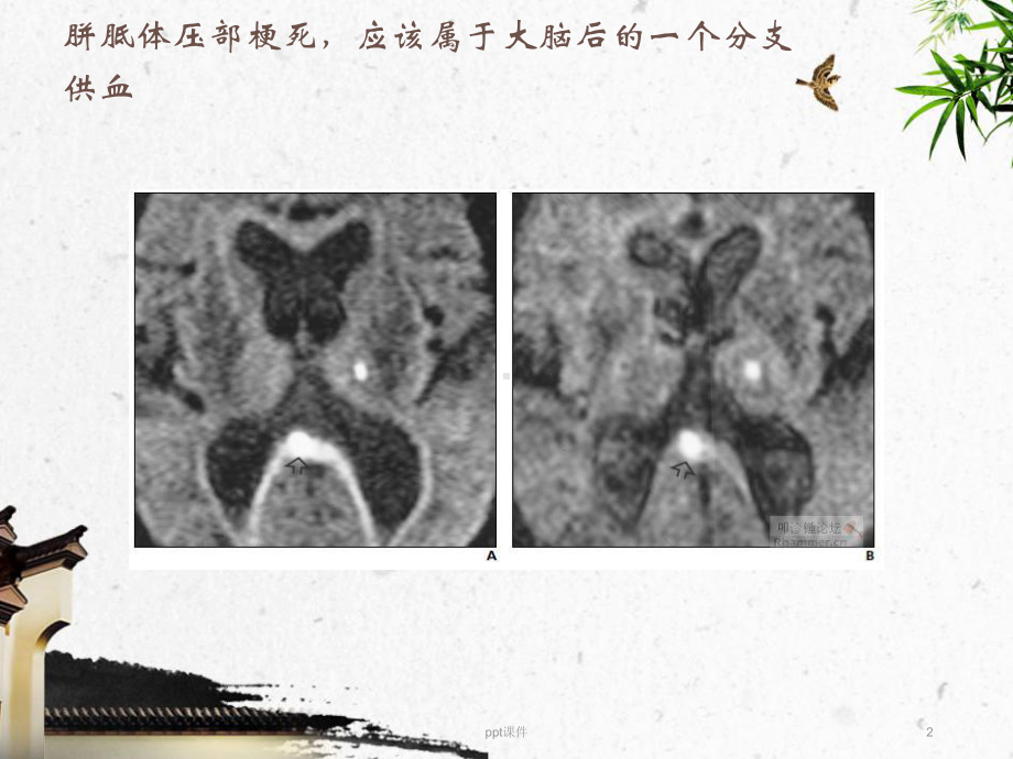 丘脑血供-ppt课件.ppt_第2页