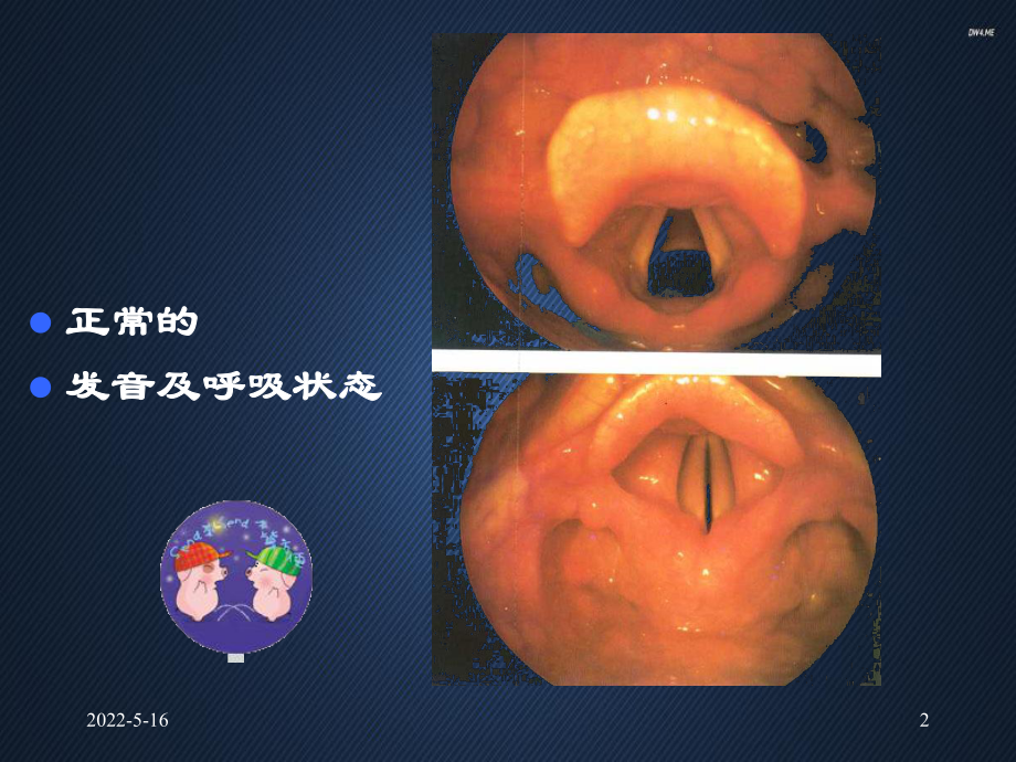 喉阻塞与急救-ppt课件.ppt_第2页