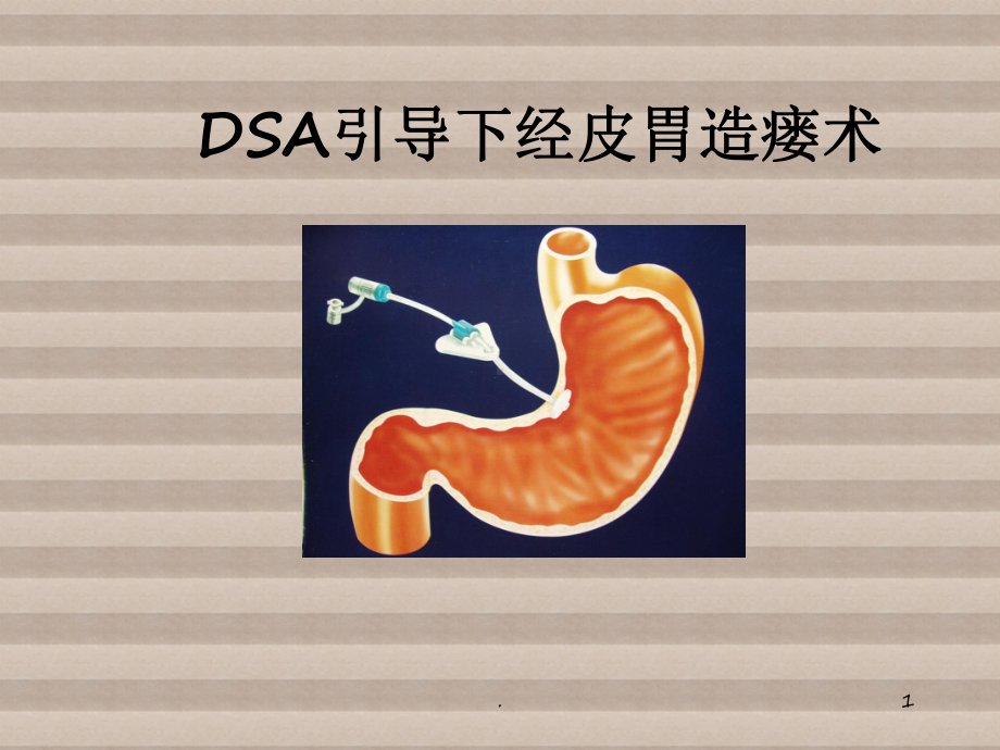 DSA引导下经皮胃造瘘术ppt演示课件.ppt_第1页