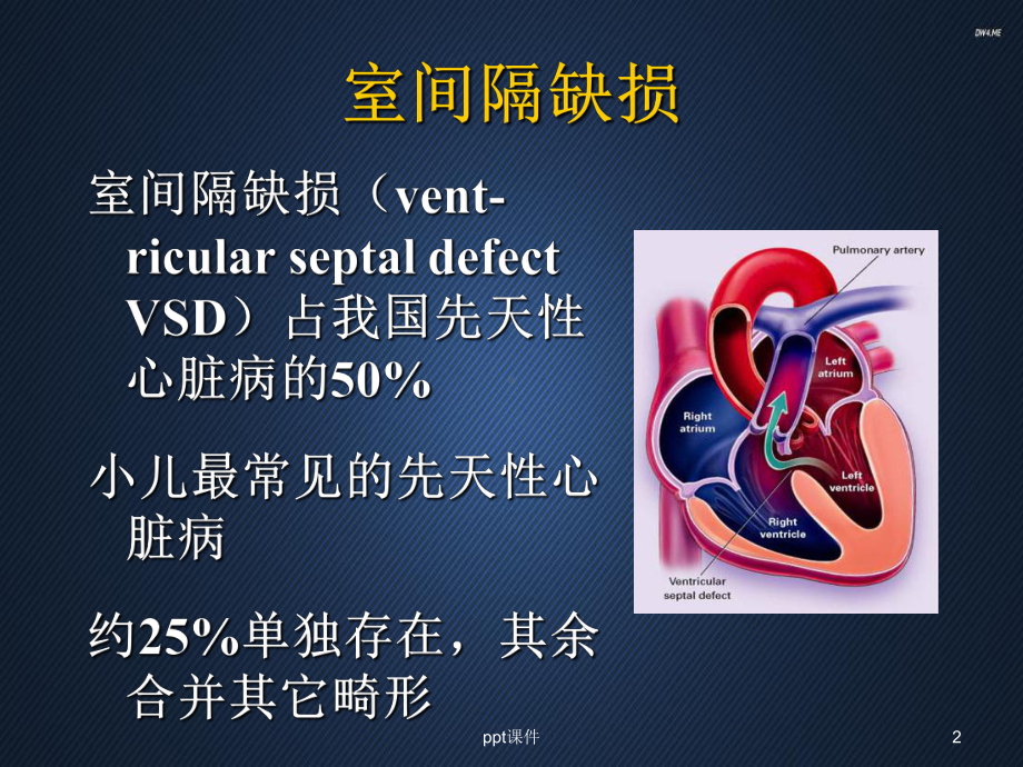 室间隔缺损-ppt课件.ppt_第2页