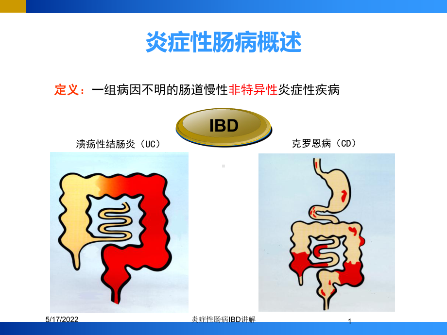 炎症性肠病IBD讲解培训课件.ppt_第1页