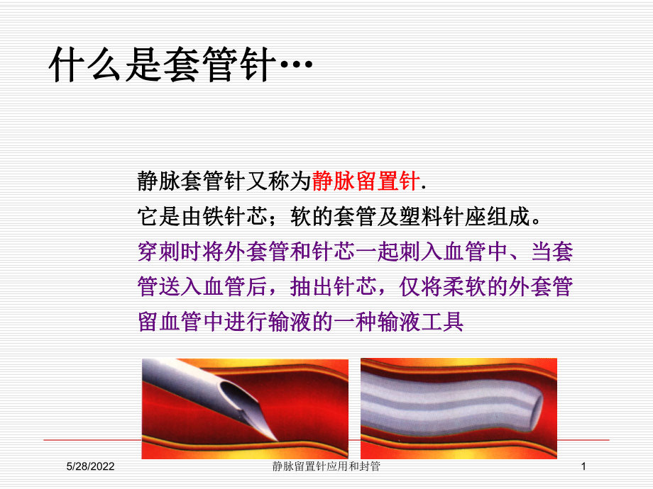 静脉留置针应用和封管培训课件.ppt_第1页