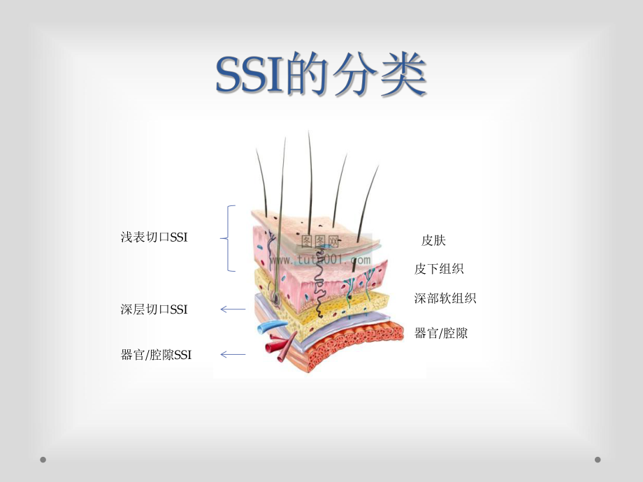 最新SSI的预防和控制主题讲座课件.ppt_第3页