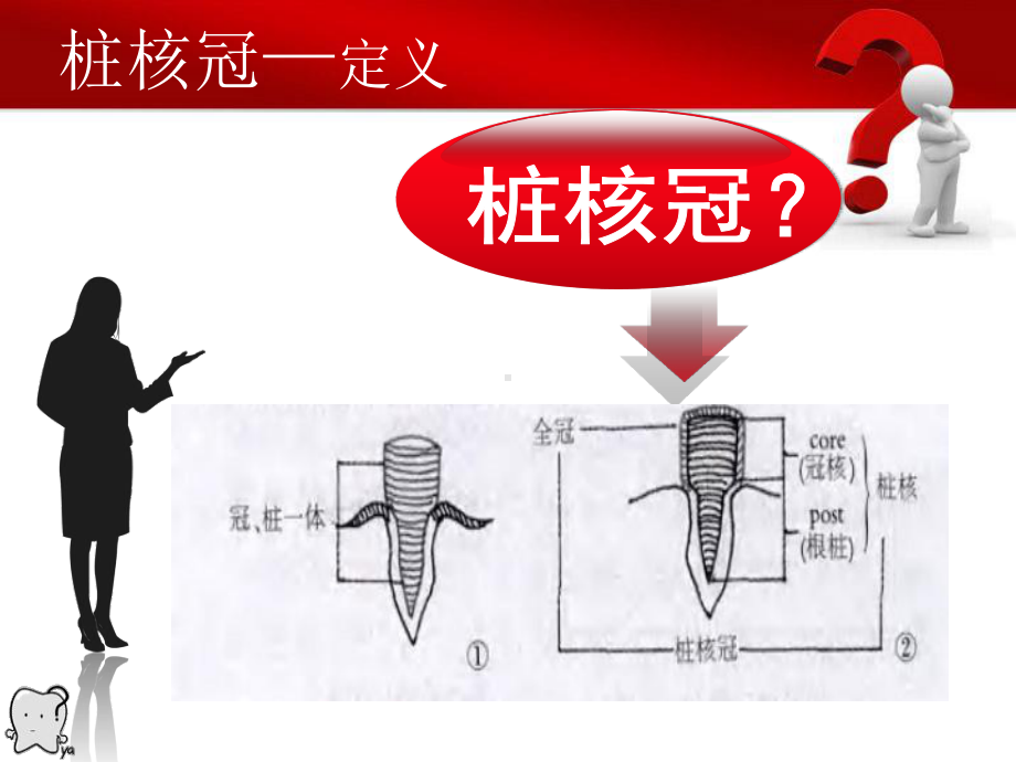 桩核冠修复浅析-PPT课件.ppt_第3页