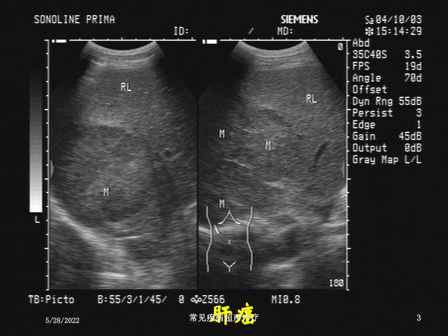 常见疾病超声诊疗课件.ppt_第3页