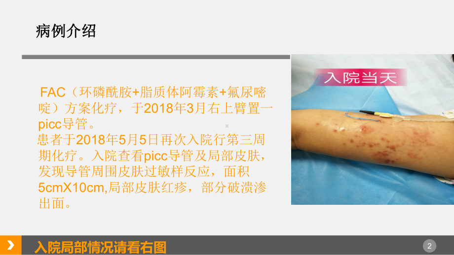 PICC案例分享(课件PPT).ppt_第2页