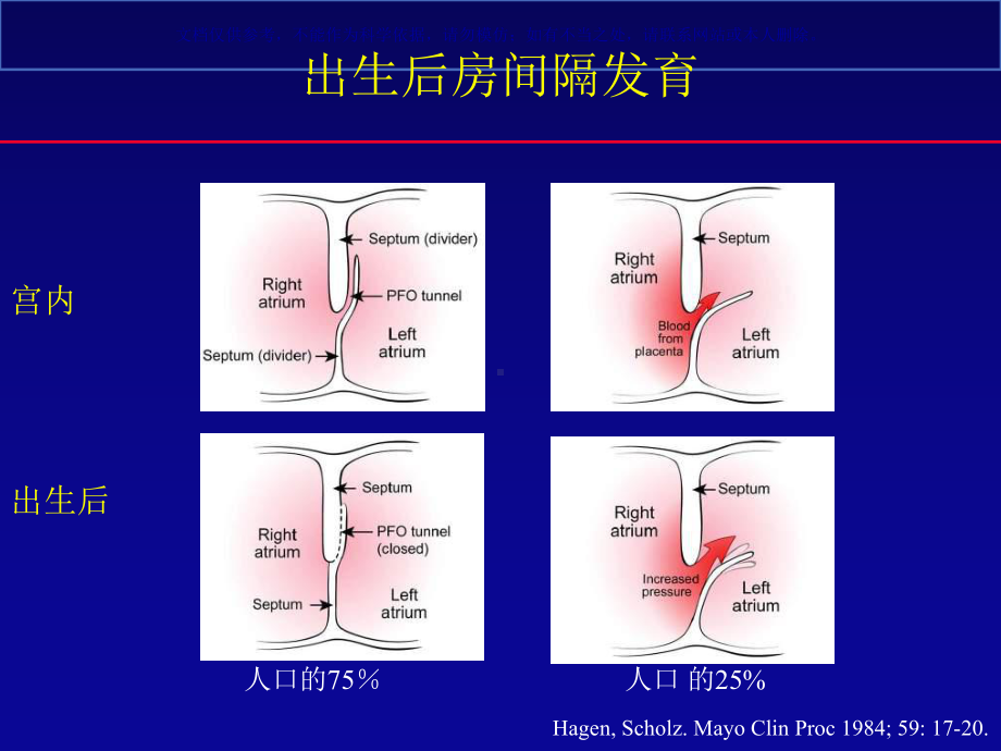 卵圆孔未闭封堵术的争论和发展课件.ppt_第2页