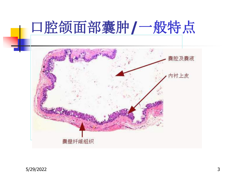 口腔颌面囊肿-ppt课件.ppt_第3页