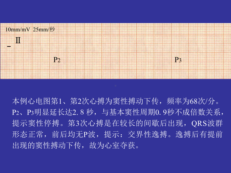 逸搏及逸搏心律PPT课件.ppt_第3页