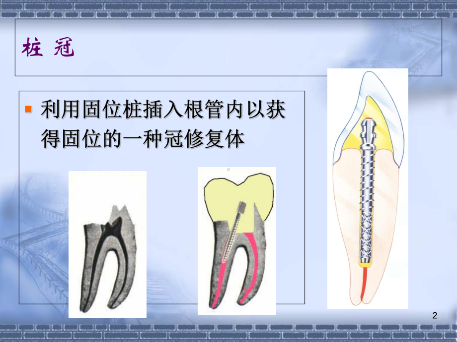 桩核冠 贴面-PPT课件.ppt_第2页