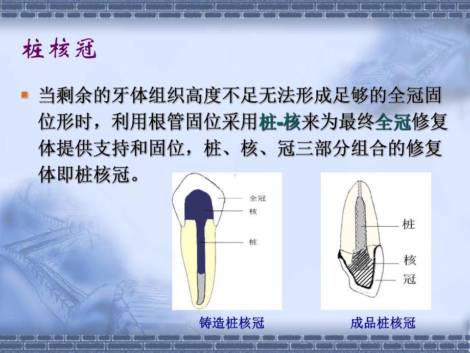 桩核冠 贴面-PPT课件.ppt_第3页