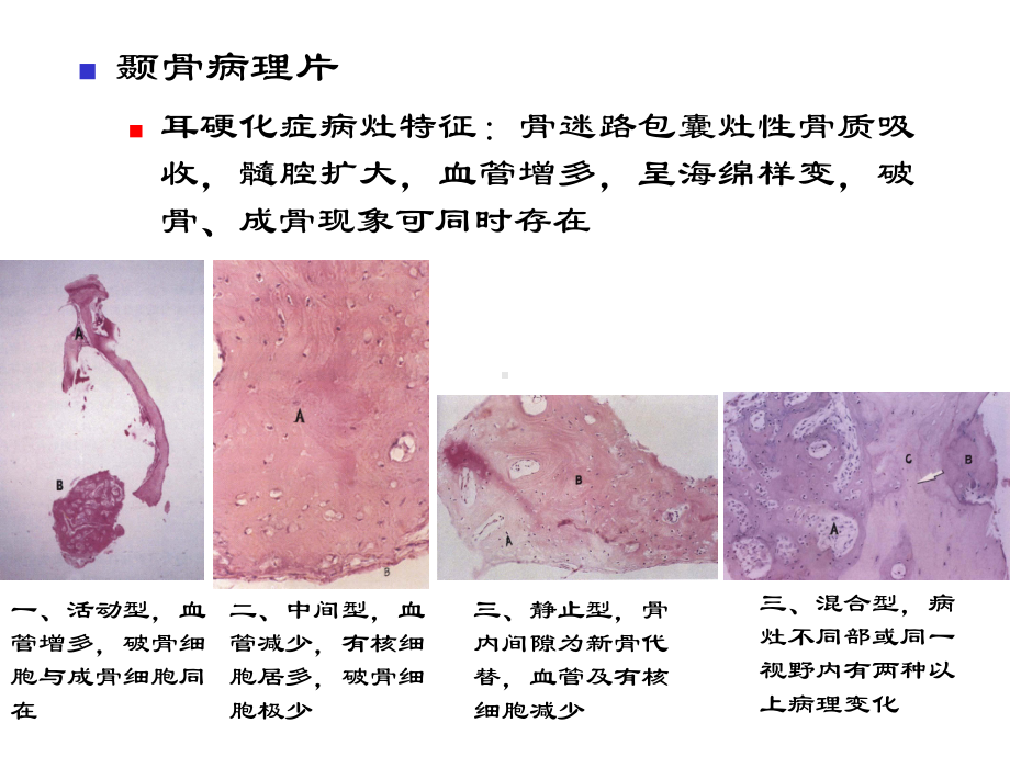 耳硬化症-301课件.ppt_第3页