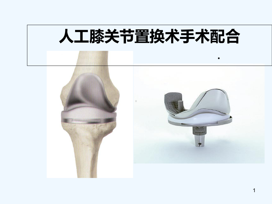 全膝关节置换术-PPT课件.ppt_第1页