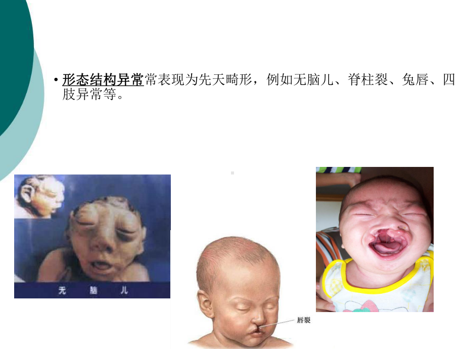 预防出生缺陷的基本知识课件.ppt_第3页