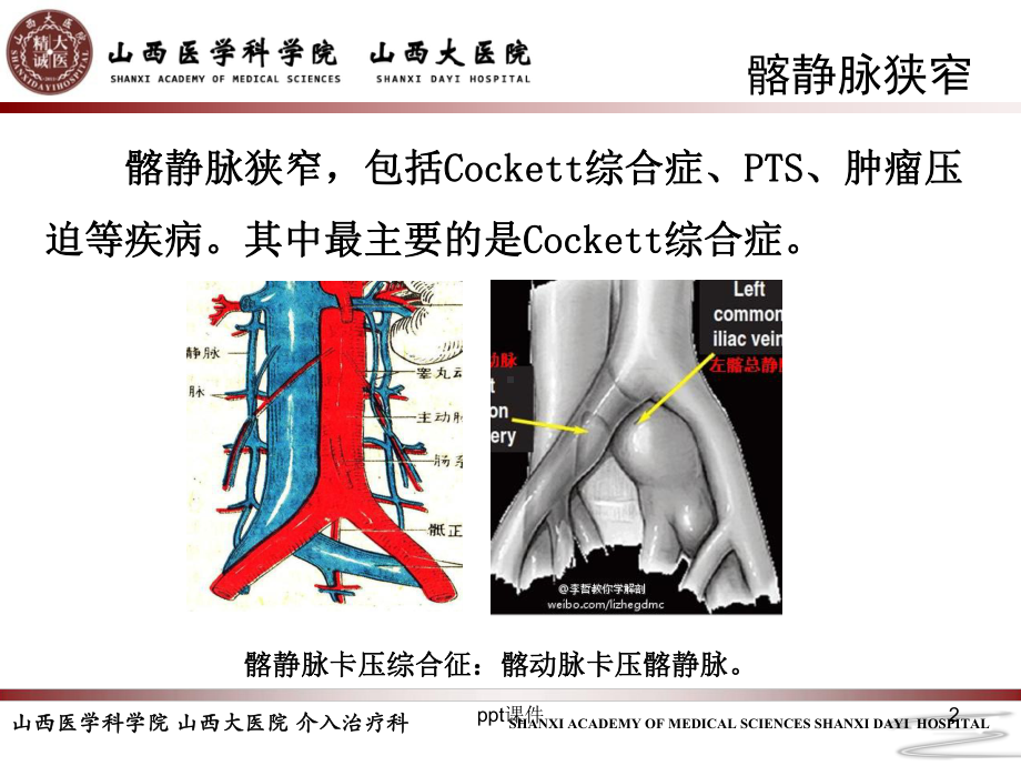 髂静脉支架的选择和支架定位-ppt课件.ppt_第2页