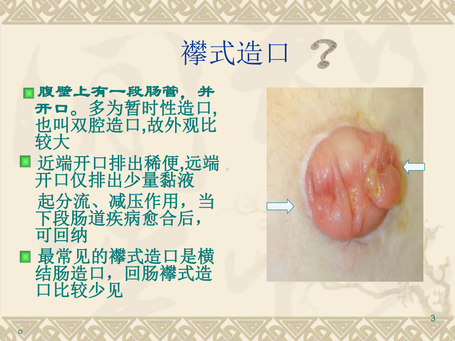 造口病人的清洁灌肠方法PPT课件.ppt_第3页