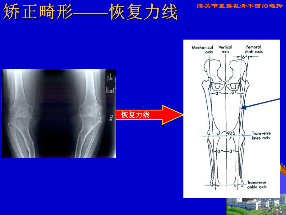 膝关节置换截骨平面的选择PPT课件.ppt_第3页