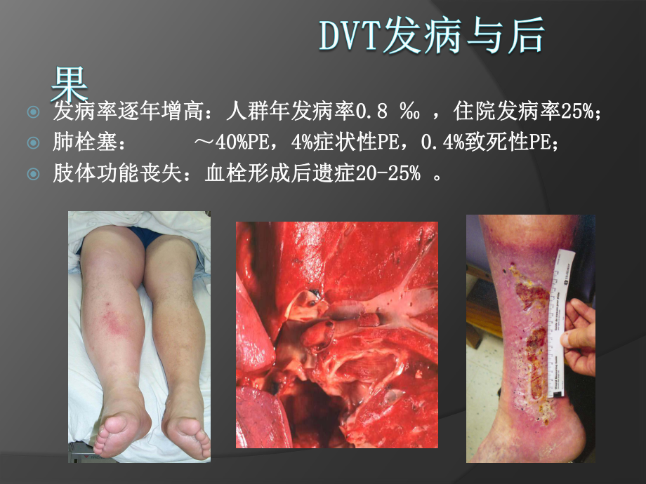 导管溶栓PPT课件.ppt_第2页