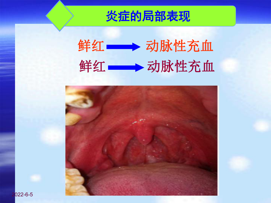 炎症局部表现与全身反应课件.ppt_第3页