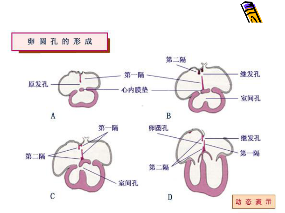 房间隔缺损.ppt课件.ppt_第2页