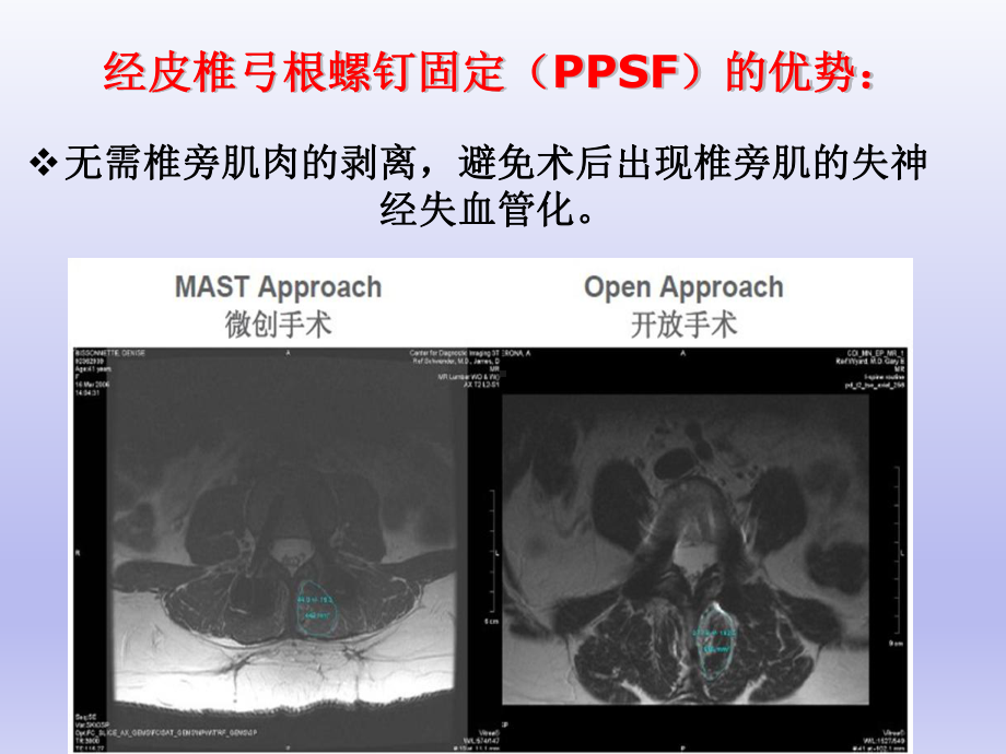 经皮椎弓根钉置入技术)课件.ppt_第2页