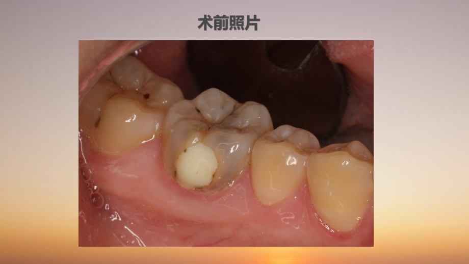 磨牙大面积缺损树脂修复课件.pptx_第2页