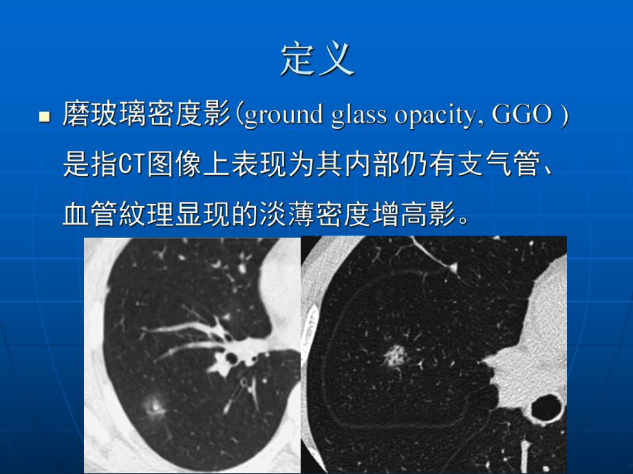 肺磨玻璃密度病变初步探讨-影像FTP课件.ppt_第2页