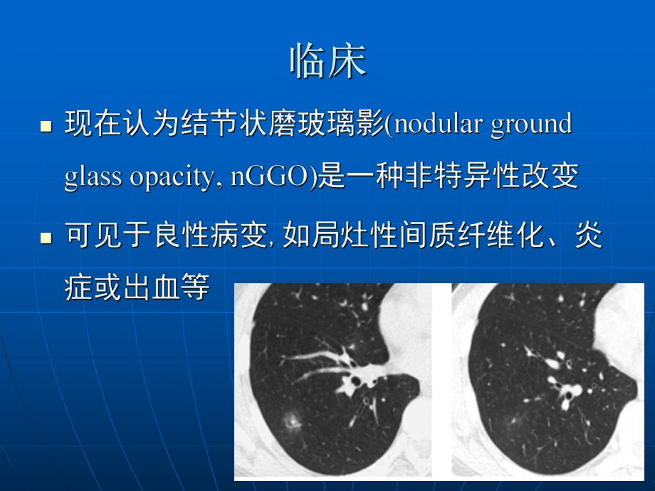 肺磨玻璃密度病变初步探讨-影像FTP课件.ppt_第3页