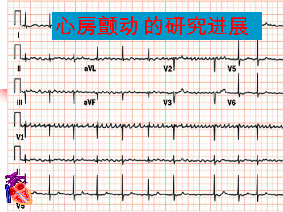 房颤的研究进展课件.ppt_第1页