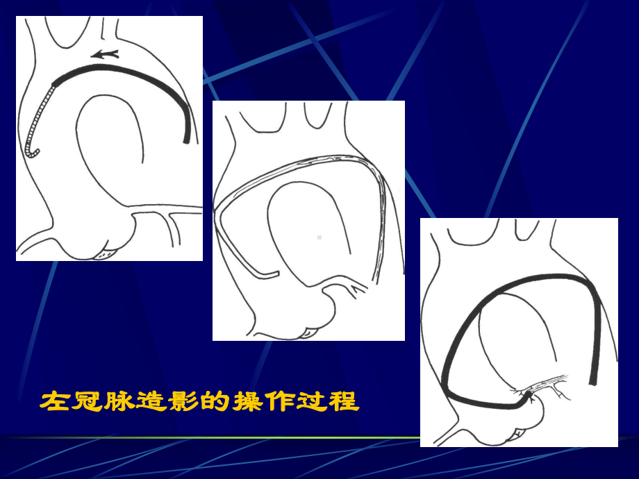 爱爱医资源-冠脉造影术简装板-绝好资料课件.ppt_第2页