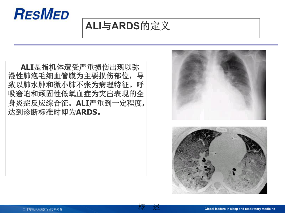 ARDS与机械通气课件.ppt_第3页