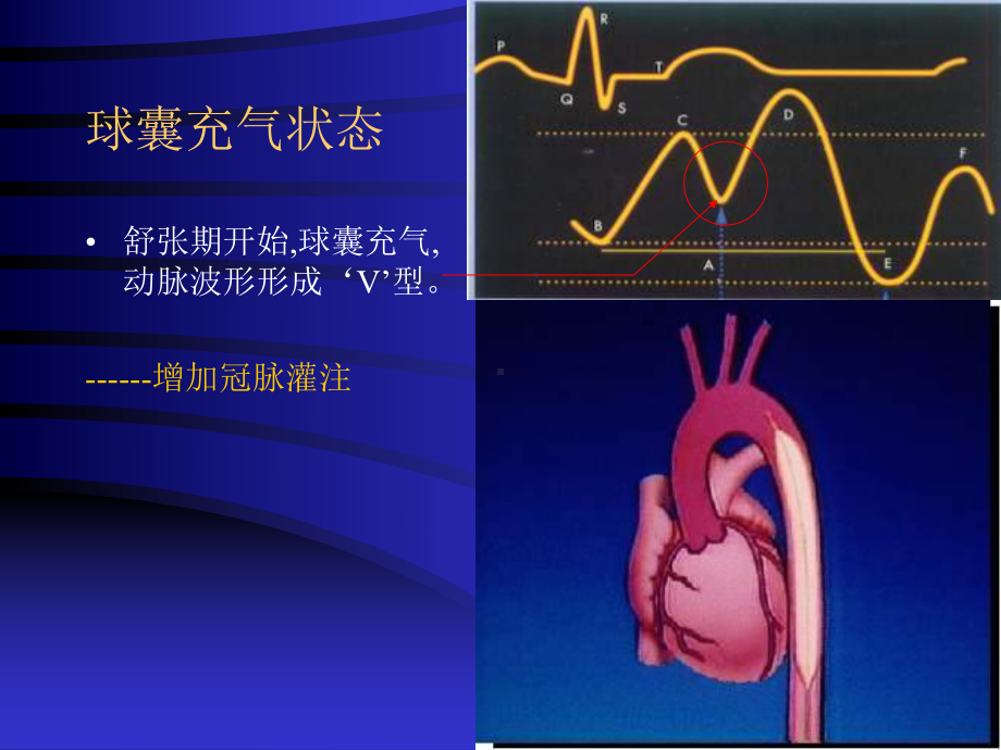 IABP使用注意事项解读课件.ppt_第3页