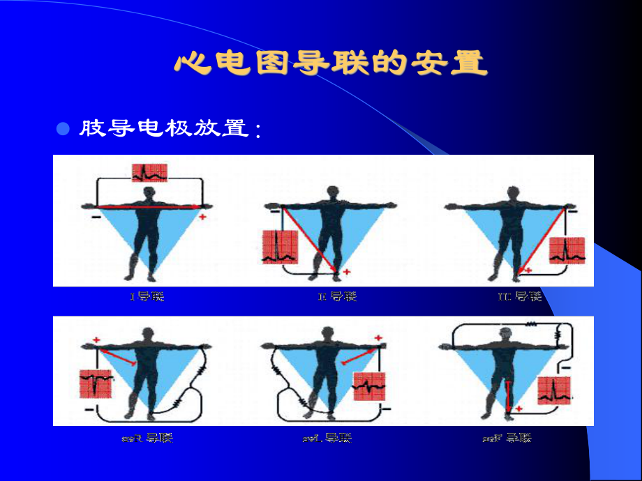 完全性RBBB右束支传导阻滞课件.ppt_第3页