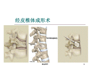 经皮椎体成形术课件.ppt