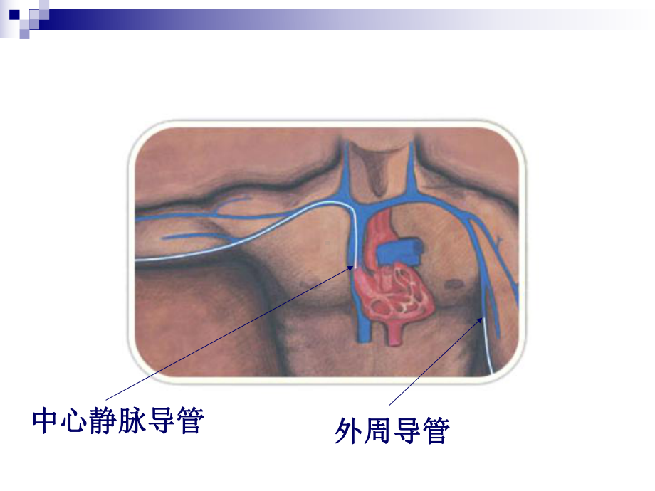 合理选择静脉输液穿刺工具-课件.ppt_第3页