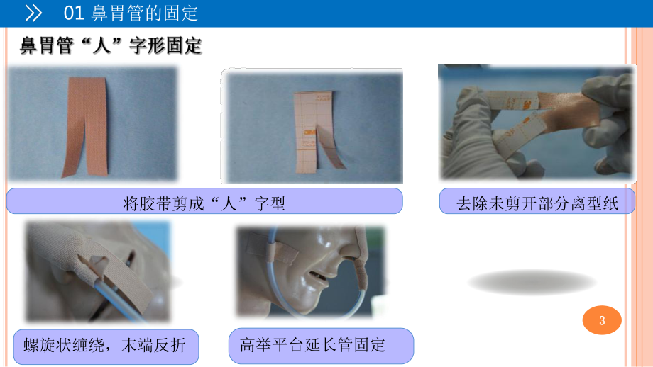 各种常见留置管道的固定方法课件.ppt_第3页