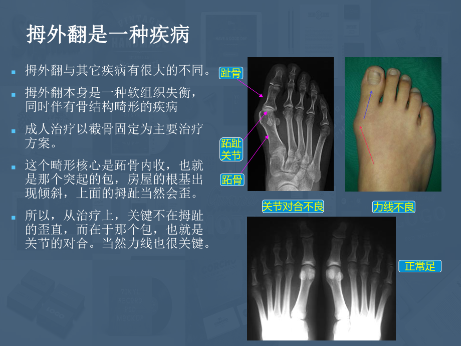 拇外翻(李昕宇)分析34页PPT课件.ppt_第1页