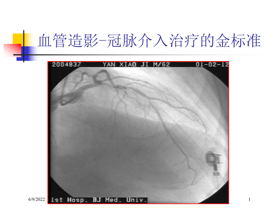 IVUS基础知识课件.ppt_第1页