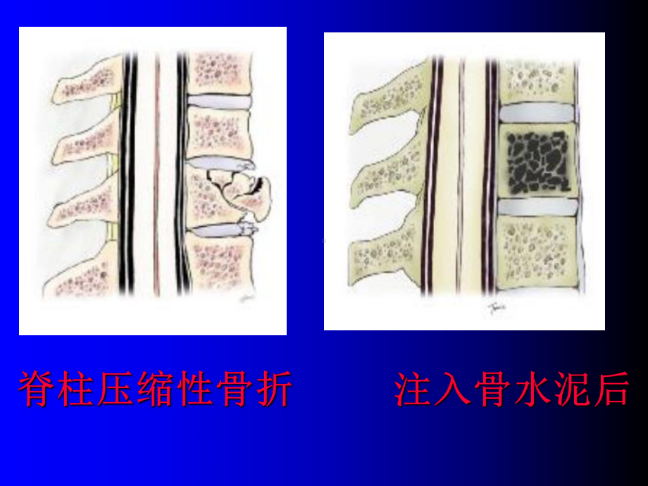 椎体成形术课件.ppt_第2页