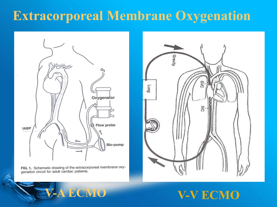 ECMO器材设备培训讲义课件.ppt_第1页