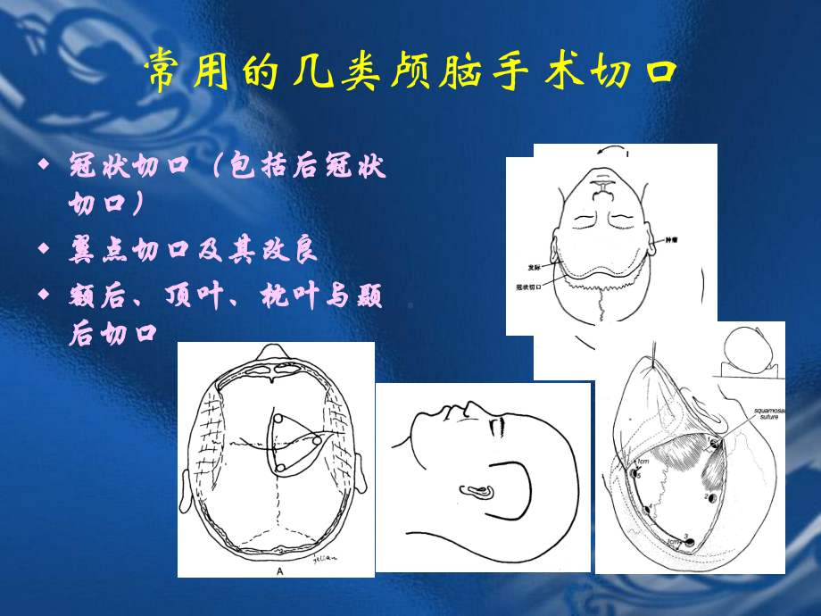 颅脑手术切口的设计原则课件.ppt_第2页