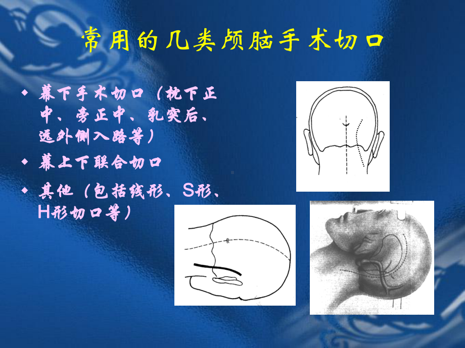 颅脑手术切口的设计原则课件.ppt_第3页