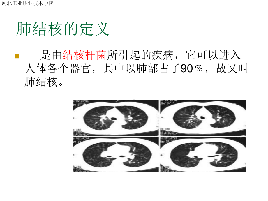 肺结核ppt完整版本课件.ppt_第3页