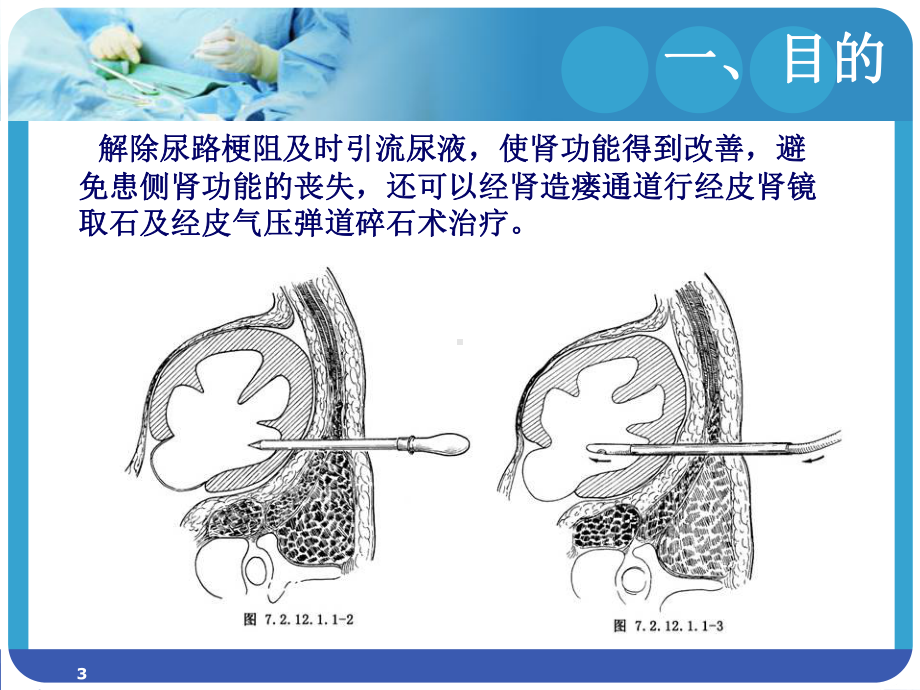 肾穿刺造瘘术的护理-PPT课件(同名69).ppt_第3页