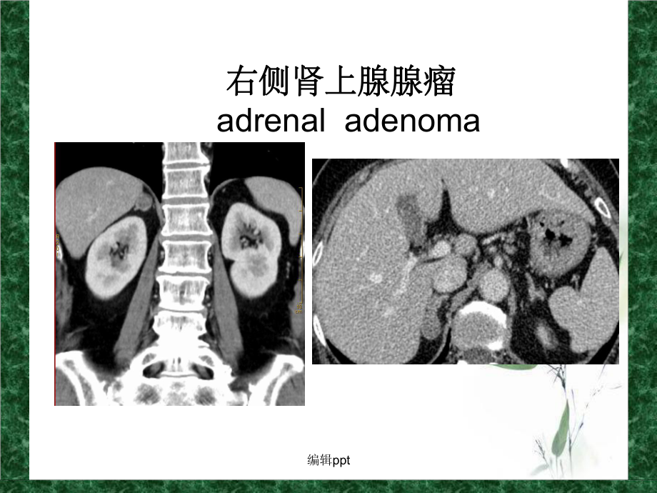 肾上腺静脉分段取血在原发性醛固酮增多症中的应用课件.ppt_第3页