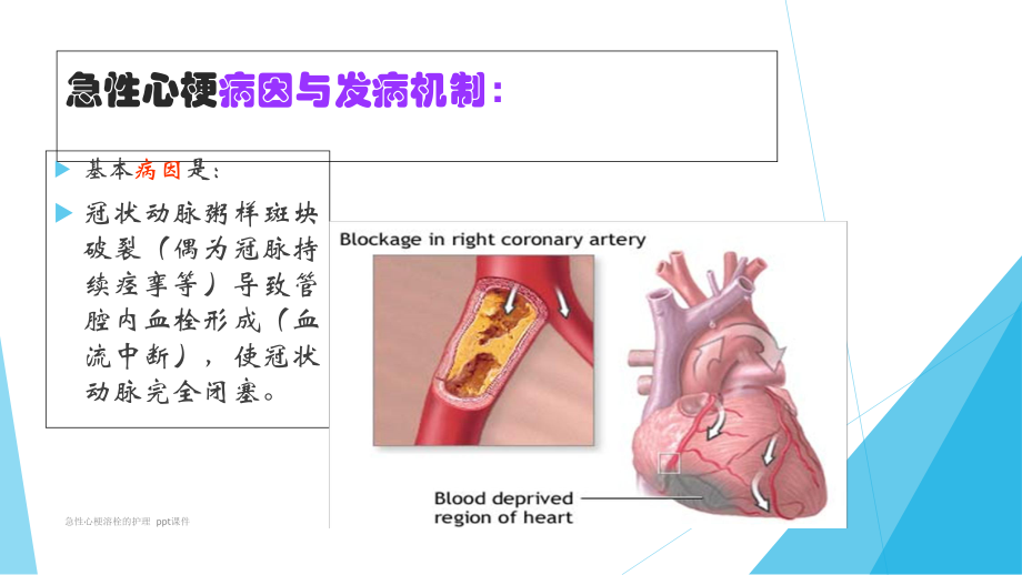 急性心梗溶栓的护理-ppt课件.ppt_第3页