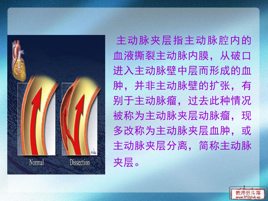 主动脉夹层的诊治ppt课件.ppt_第2页