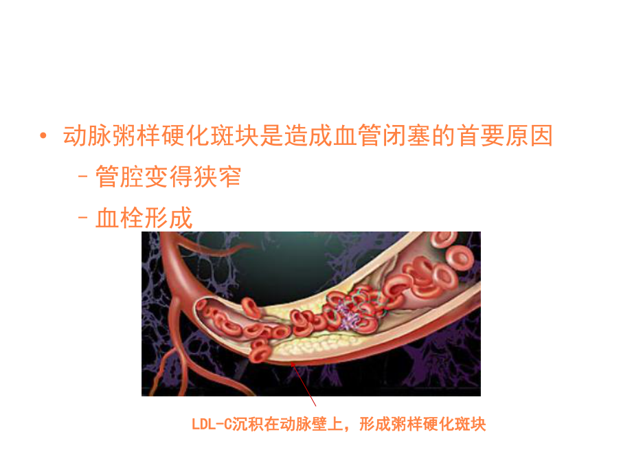 心肌梗死健康宣教PPT课件.ppt_第3页