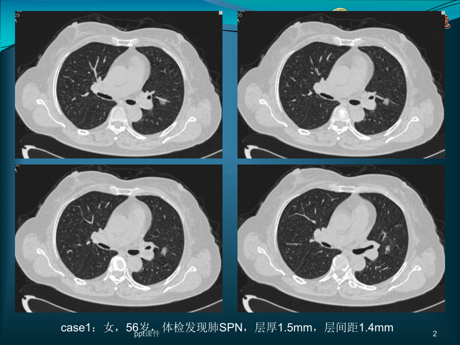 肺结节的检出与处理对策-ppt课件.ppt_第2页